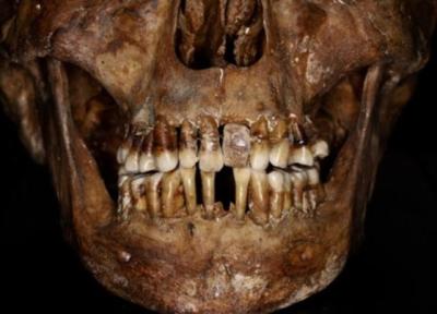 یک اشراف زاده قرن هفدهمی رازی مبتکرانه برای حفظ دندان هایش داشت